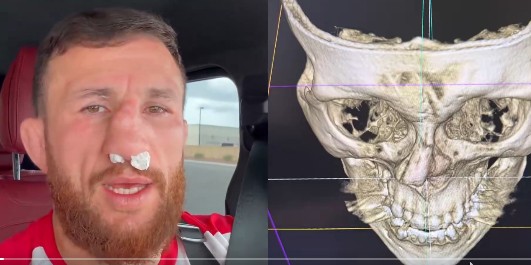 ოპერაცია სჭირდება, თუმცა... - მერაბ დვალიშვილმა ცხვირი კიდევ უფრო გაიტეხა,